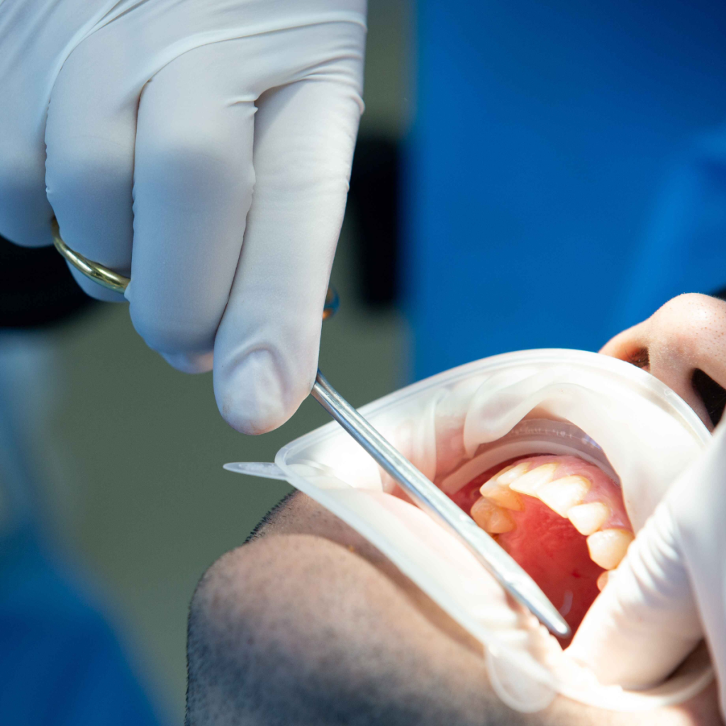 tooth extraction