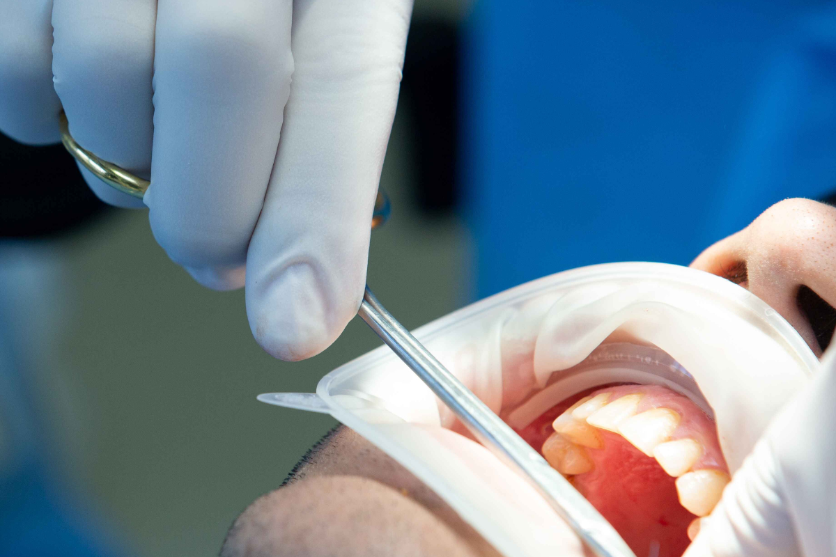 tooth extraction